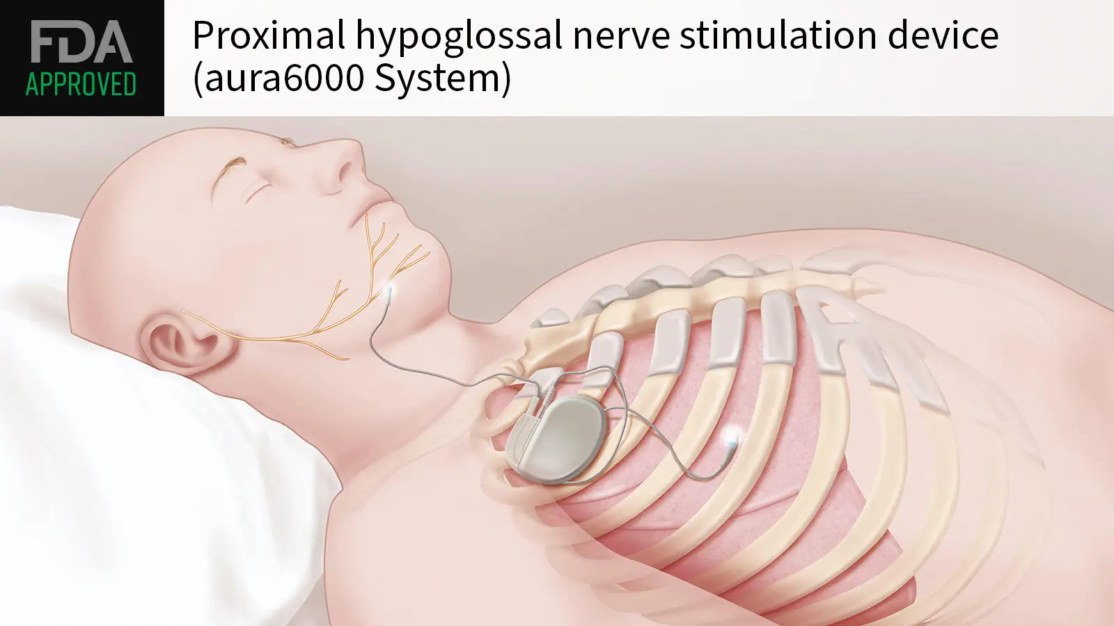Next-Gen Nerve Stimulator Approved for Obstructive Sleep Apnea