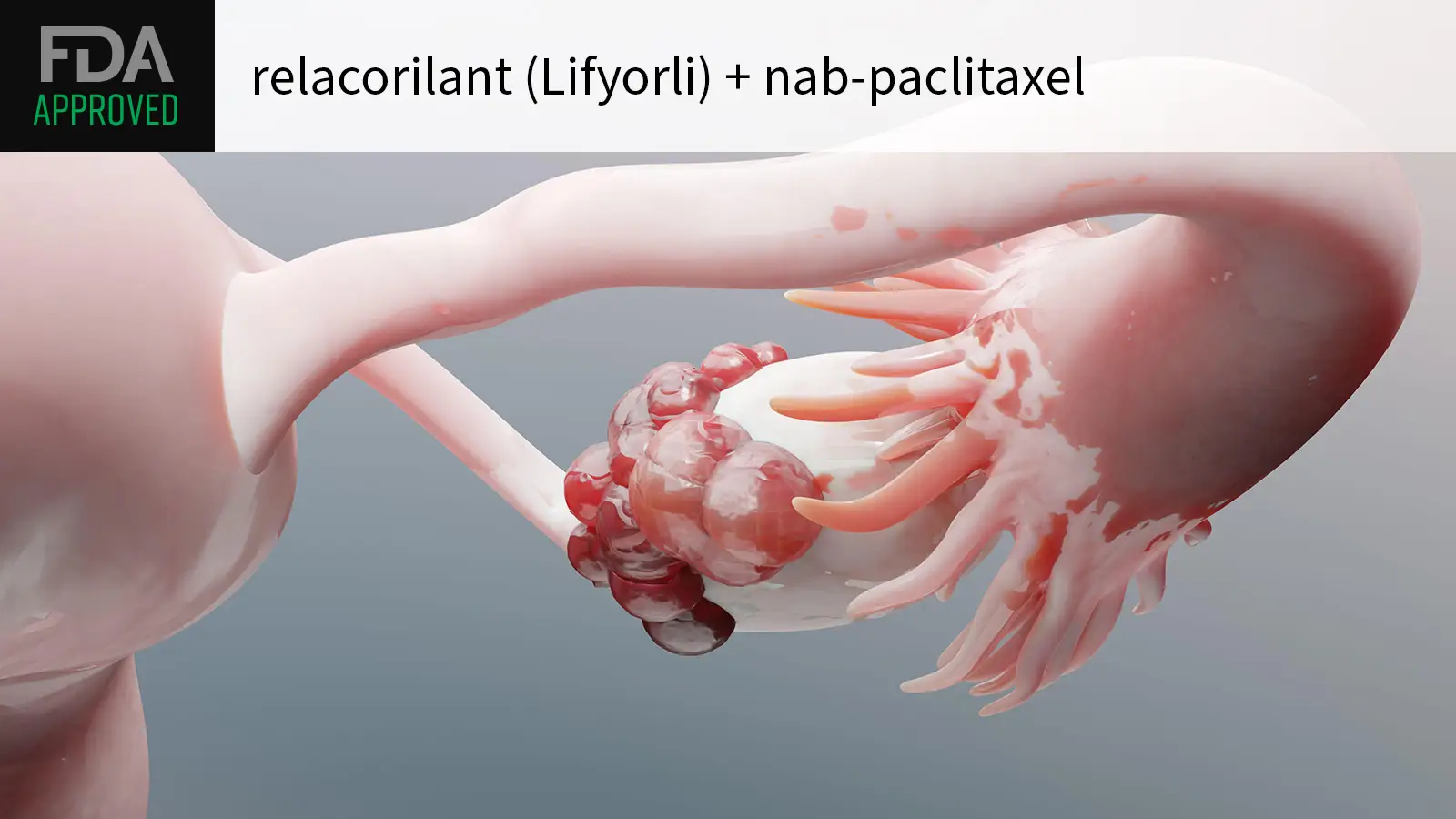 FDA Approves New Drug Combo for Tough-to-Treat Ovarian Cancer