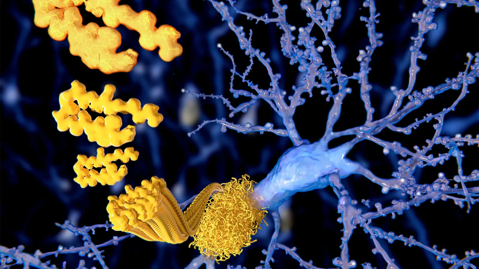 Brain Disease Decades Later? Study Links Childhood Surgery to Amyloid Build-Up