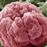 Complement Inhibitor Slowed Kidney Decline in IgA Nephropathy