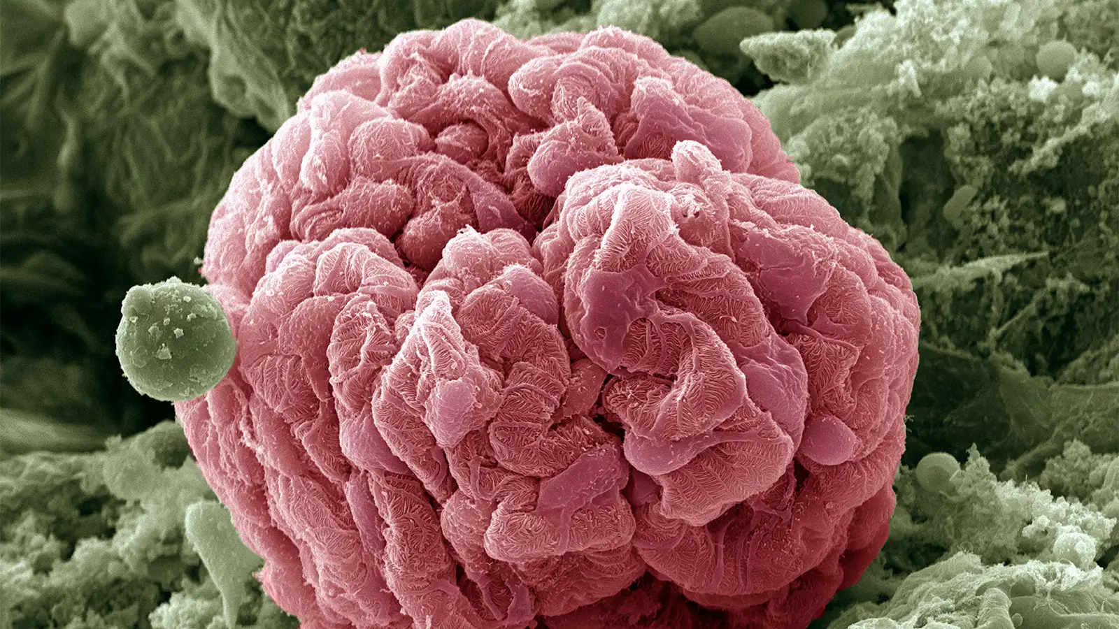 Complement Inhibitor Slowed Kidney Decline in IgA Nephropathy