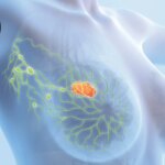 Low Breast Cancer Recurrence Rate With Radiotherapy Tailored to Nodal Response
