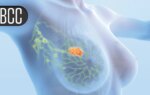 Low Breast Cancer Recurrence Rate With Radiotherapy Tailored to Nodal Response