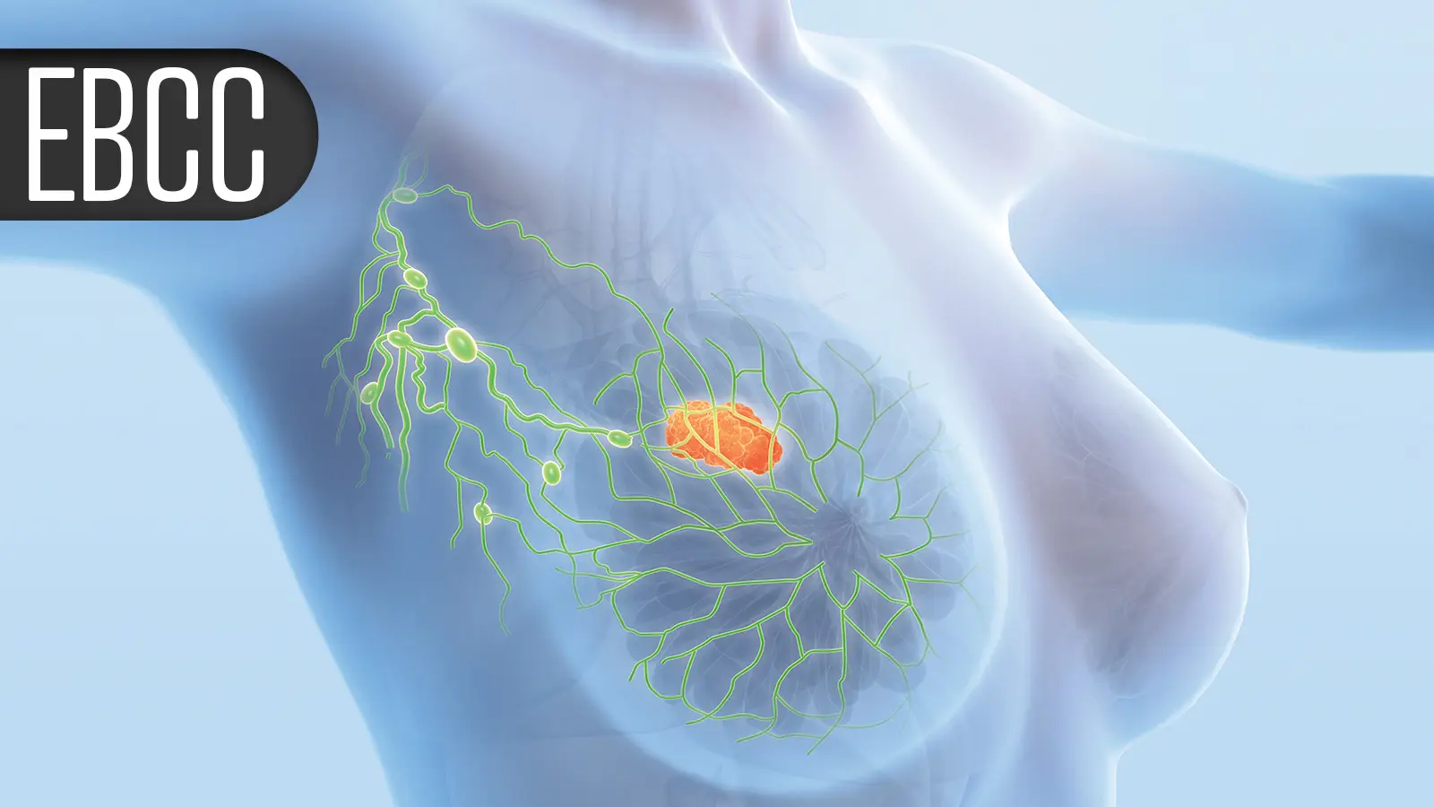 Low Breast Cancer Recurrence Rate With Radiotherapy Tailored to Nodal Response