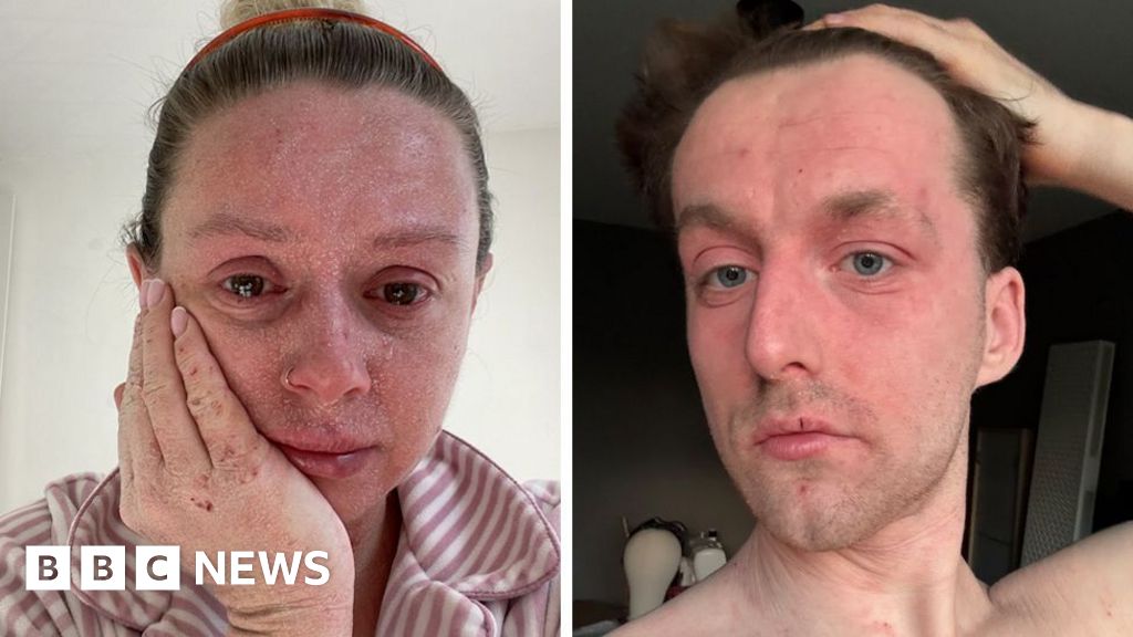 'Our skin is falling off and no-one can tell us why '