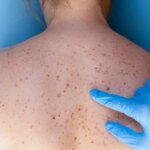 New TYK2 Inhibitors for Psoriasis Achieve High Clearance Rates in Randomized Trials