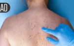 New TYK2 Inhibitors for Psoriasis Achieve High Clearance Rates in Randomized Trials