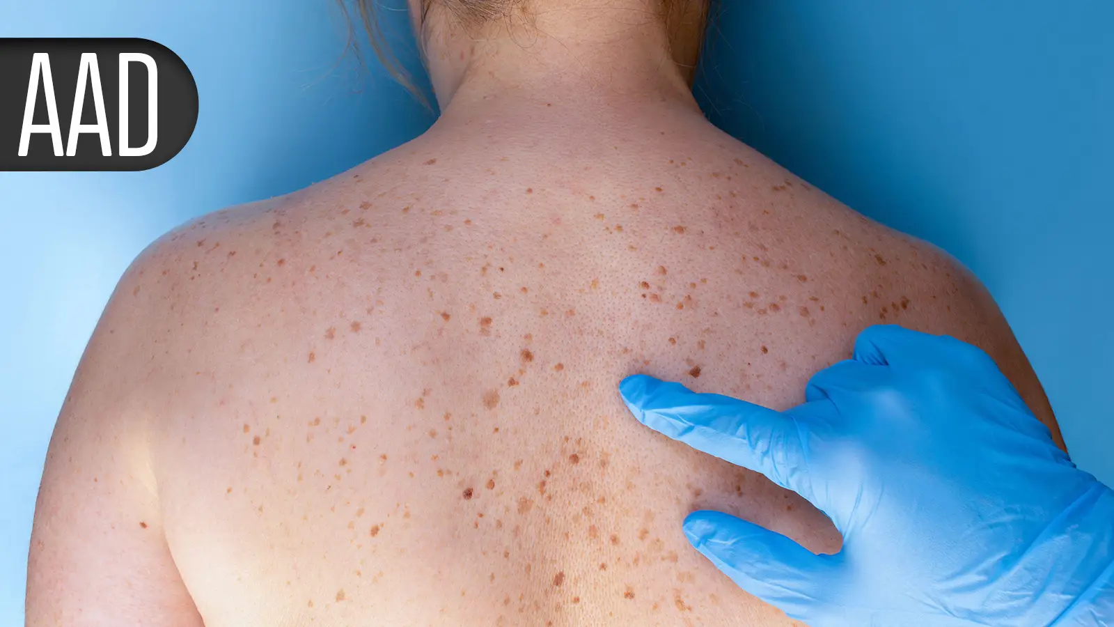 New TYK2 Inhibitors for Psoriasis Achieve High Clearance Rates in Randomized Trials