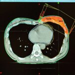 Modern Radiotherapy for Breast Cancer Likely Cut Heart Disease Risk