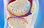 This Growth Factor May Play a Bigger Role in Osteoarthritis Than Previously Thought