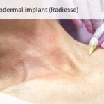 Despite Concerns Over Breast Screening, FDA OKs New Use for Dermal Filler