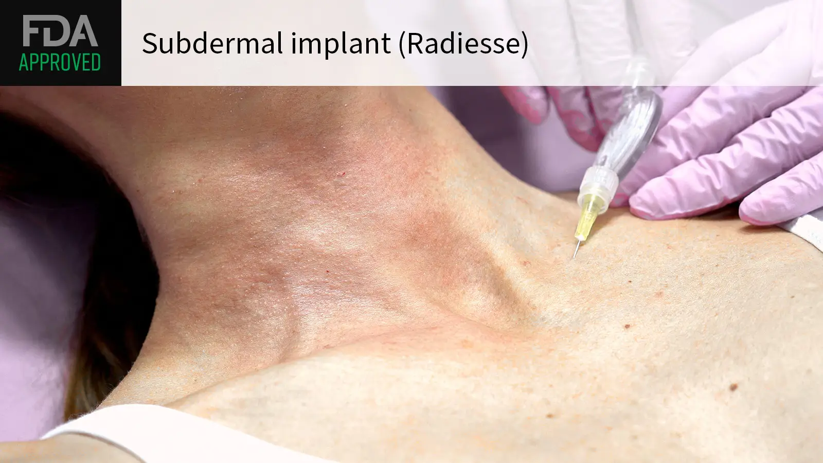 Despite Concerns Over Breast Screening, FDA OKs New Use for Dermal Filler