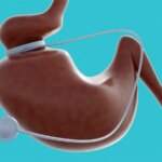 Call to Integrate Obesity Management With Surgery, GLP-1s Into Cancer Care