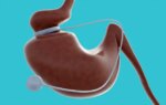 Call to Integrate Obesity Management With Surgery, GLP-1s Into Cancer Care