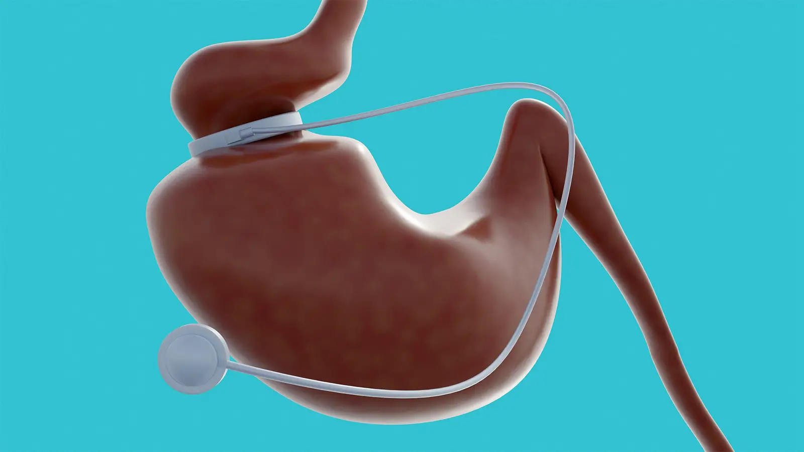 Call to Integrate Obesity Management With Surgery, GLP-1s Into Cancer Care