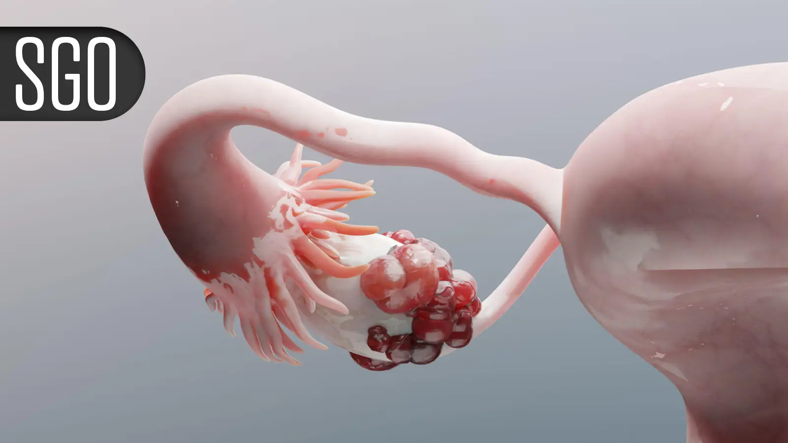 'Amazing' Results With Drug Combo in Metastatic Cervical Cancer