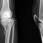 One Intrawound Antibiotic Wins for Surgical Infections After Tibial Fracture Surgery