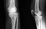 One Intrawound Antibiotic Wins for Surgical Infections After Tibial Fracture Surgery
