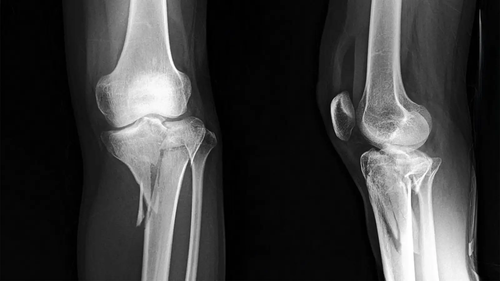 One Intrawound Antibiotic Wins for Surgical Infections After Tibial Fracture Surgery