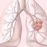 Early Lung Cancer Data Show Why FDA Approved HER2 Agent in First-Line