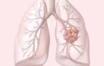 Early Lung Cancer Data Show Why FDA Approved HER2 Agent in First-Line