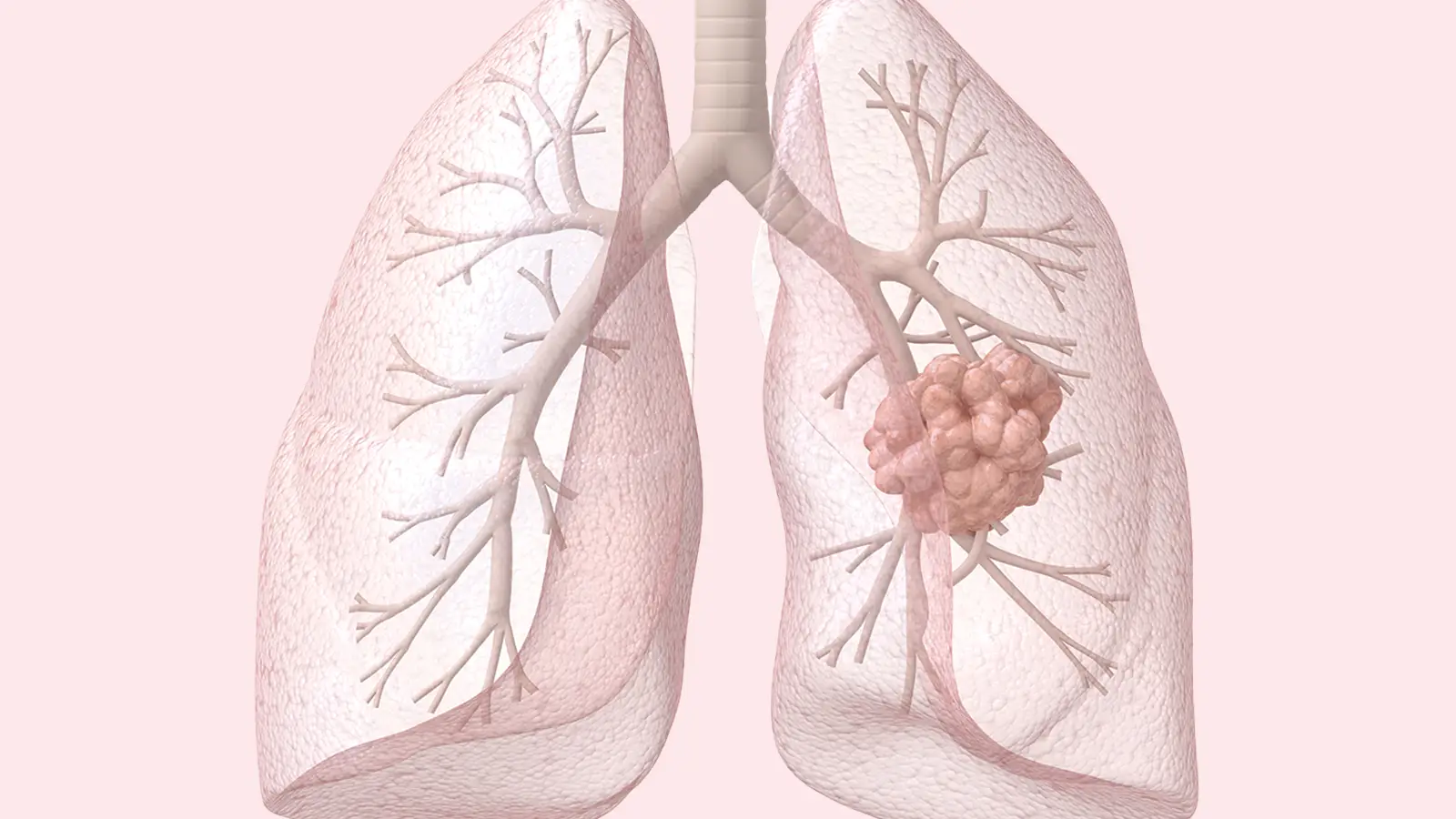 Early Lung Cancer Data Show Why FDA Approved HER2 Agent in First-Line