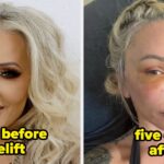 Celebrities Before And After Facelifts