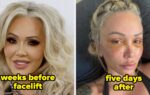 Celebrities Before And After Facelifts