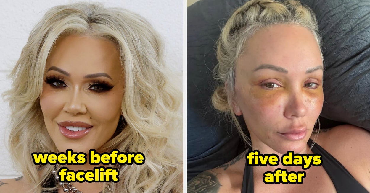 Celebrities Before And After Facelifts