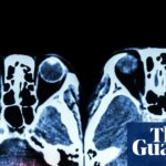 Key stroke treatment still not available around the clock across England | Stroke