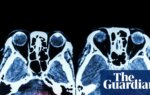Key stroke treatment still not available around the clock across England | Stroke