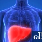 Raise tax on alcohol and junk food to cut deaths from liver disease, experts say | Health