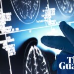 Effect of ‘gamechanger’ Alzheimer’s drugs ‘trivial’, review concludes | Dementia
