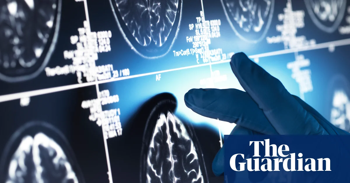 Effect of ‘gamechanger’ Alzheimer’s drugs ‘trivial’, review concludes | Dementia