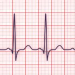 Novel ICD Lead for Conduction System Pacing Enters the Arena