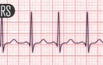 Novel ICD Lead for Conduction System Pacing Enters the Arena