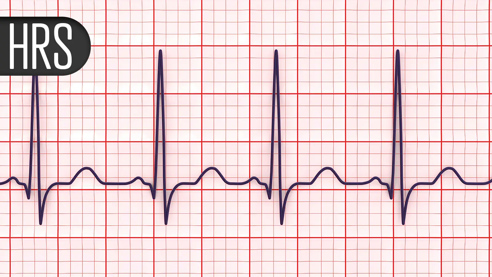 Novel ICD Lead for Conduction System Pacing Enters the Arena