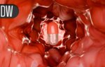 Colonoscopy Trial Highlights Strengths, Weaknesses in Benefits