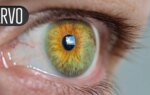 VEGF Inhibitor Implant Preserves Visual Acuity, Retinal Anatomy in Wet AMD