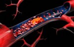 Endovascular Thrombectomy Boosts Outcomes in Medium-Vessel Ischemic Stroke