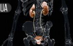 Durvalumab Plus BCG Cut Early Recurrence of High-Risk Bladder Cancer