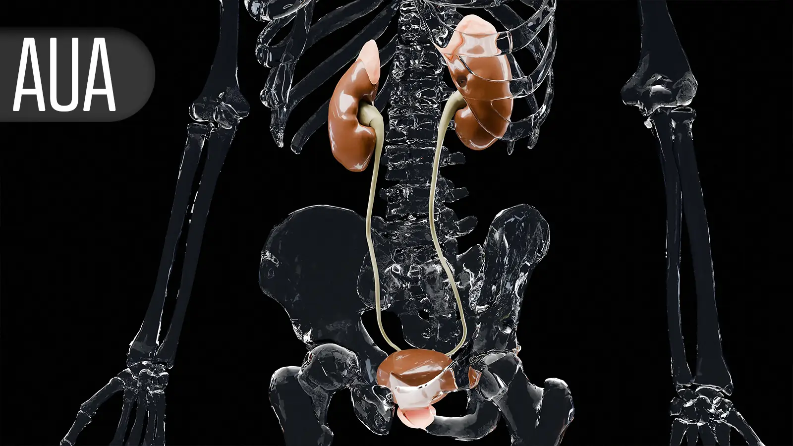 Low-Intensity Ultrasound Shatters Kidney Stones in 70% of SOUND Trial Patients