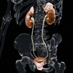 Temporary Prostatic Urethra Expander for BPH/LUTS Shows Durable Results