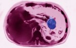 Pancreatic Cancer Risk Much Higher for Certain Group, Study Suggests