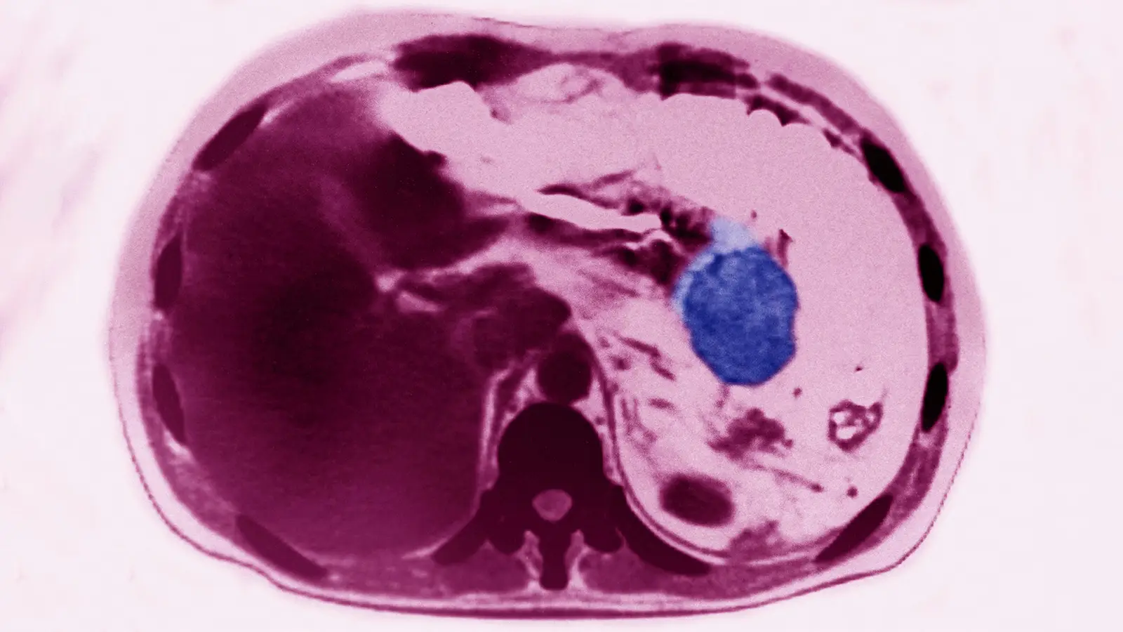 Pancreatic Cancer Risk Much Higher for Certain Group, Study Suggests