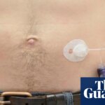 NHS rollout of artificial pancreas narrows inequality in diabetes care | Diabetes