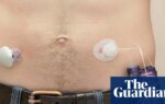NHS rollout of artificial pancreas narrows inequality in diabetes care | Diabetes