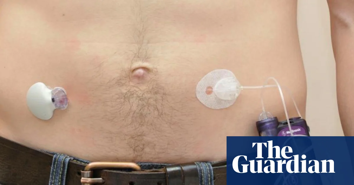 NHS rollout of artificial pancreas narrows inequality in diabetes care | Diabetes