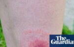 Lyme disease cases in England rise by more than 20% in a year | Lyme disease
