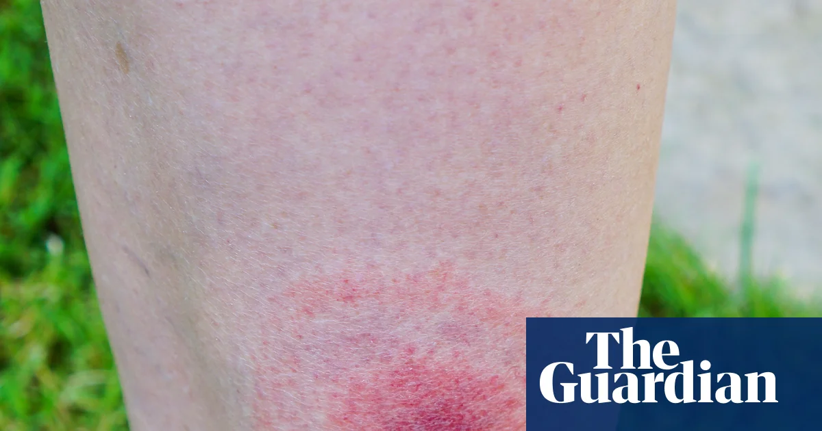Lyme disease cases in England rise by more than 20% in a year | Lyme disease